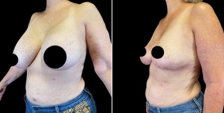 Implant Removal Results